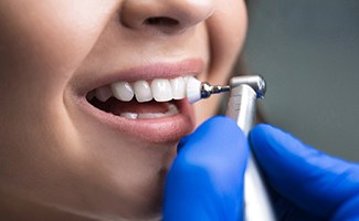 Closeup of smile being polished by Reno dentist