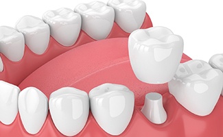 diagram of a dental crown in Reno for the FAQ section