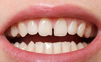  Closeup of gap between front teeth in Reno before Invisalign 