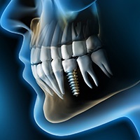 X-ray of a patient with a dental implant 