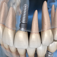 dental implant in the upper arch 