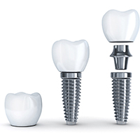 the three parts of a dental implant 