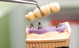 Dental bridge in Reno designed to attach to dental implants