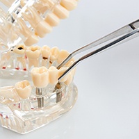Reno implant dentist placing implant bridge in Reno on model jaw