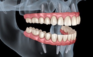 A 3D illustration of all-on-4 dentures