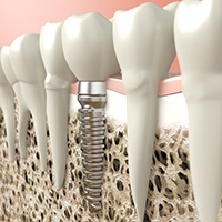 Digital illustration of dental implant