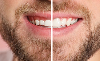 A man’s smile before and after gum recontouring