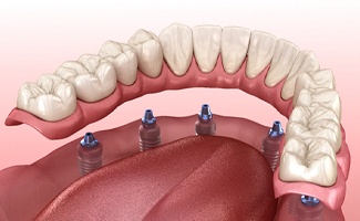 Model of implant dentures in Reno, NV being attached to lower arch