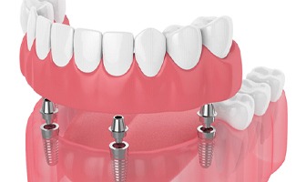 Implant dentures in Reno, NV being attached to four implant posts