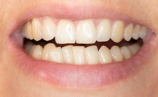  Closeup of crowded teeth in Reno before Invisalign 