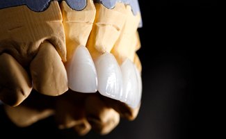 model mouth with porcelain veneers attached to it