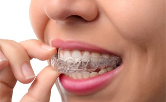 A woman with clear aligners