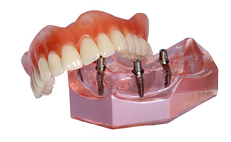 Implant supported denture model