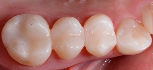 anterior crowns