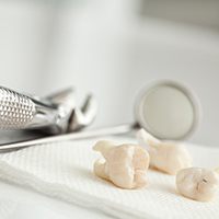 Three extracted teeth on gauze next to dental mirror and forceps