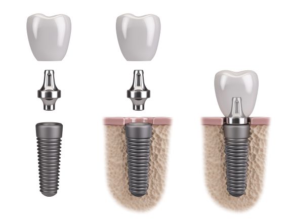 side view of dental implant