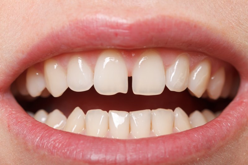 Diastema