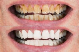 A “before” and “after” photo comparison of yellow, decaying teeth and white, healthy-looking teeth