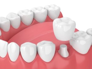 3D illustration of dental crown 