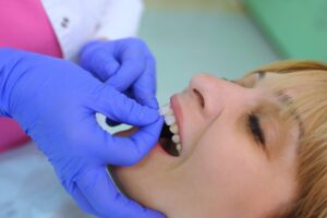 Woman having veneer applied to teeth. 