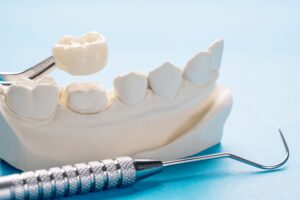 Tweezers holding dental crown above cast of lower arch